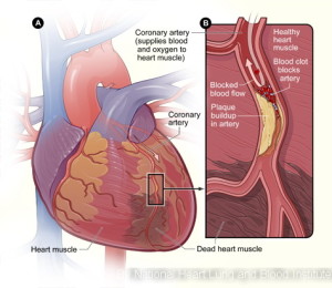 Hdw_heartattack